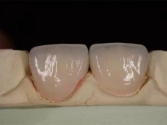深圳義齒加工、烤瓷牙加工、全瓷牙加工、種植牙加工、牙齒加工廠(chǎng)